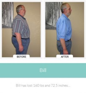 chirothin before and after photos bill